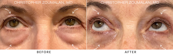 Quad Blepharoplasty Before & After Photo - Patient Seeing Up - Patient 9B