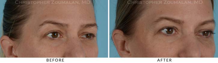 Facial Nerve Paralysis (Bell’s Palsy) Before & After Photo - Patient Seeing Side - Patient 1D