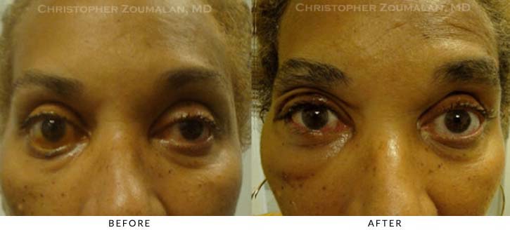 Facial Nerve Paralysis (Bell’s Palsy) Before & After Photo - Patient Seeing Straight - Patient 3