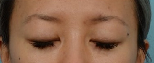 How do Eyelid Scars Heal Before & After Photo - Asian Eyelid Surgery (Double Eyelid Surgery) - Patient 6