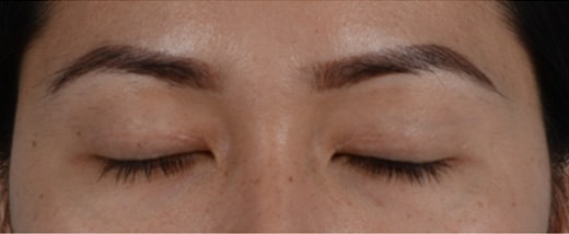 How do Eyelid Scars Heal Before & After Photo - Asian Eyelid Surgery (Double Eyelid Surgery) - Patient 5