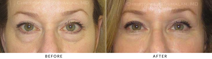 Hyaluronic acid fillers to the orbital rim (tear trough) and midface. In this patient, Restylane was used below the eyelid bags.