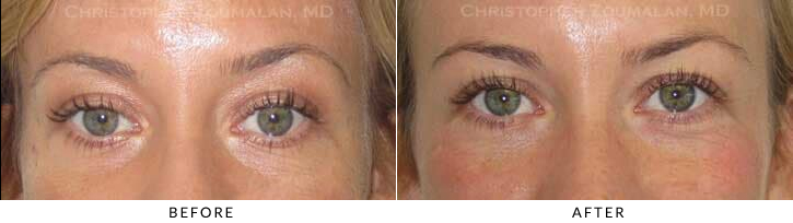 Hyaluronic acid fillers were injected along her eyelid/cheek area to improve her volume loss and restore a more refreshed look.