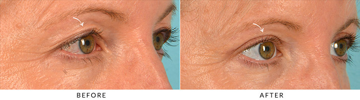 Upper Lid Blepharoplasty Before & After Photo - Patient Seeing Side - Patient 2B