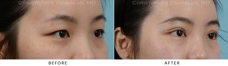 Asian Eyelid (Double Eyelid) Surgery Before & After Photo - Patient Seeing Side - Patient 10A