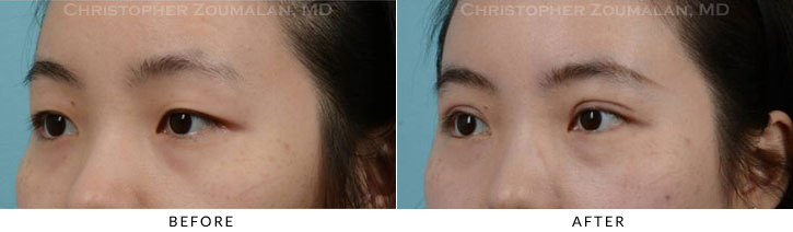 Asian Eyelid (Double Eyelid) Surgery Before & After Photo - Patient Seeing Side - Patient 10B