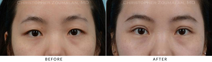 Asian Eyelid (Double Eyelid) Surgery Before & After Photo - Patient Seeing Straight - Patient 10C