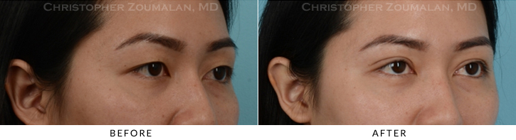 Asian Eyelid (Double Eyelid) Surgery Before & After Photo - Patient Seeing Side - Patient 11A