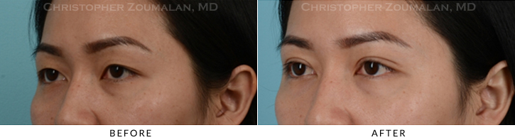 Asian Eyelid (Double Eyelid) Surgery Before & After Photo - Patient Seeing Side - Patient 11B