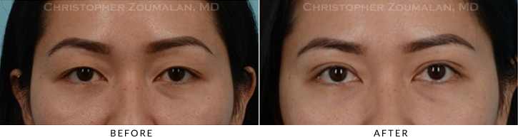 Asian Eyelid (Double Eyelid) Surgery Before & After Photo - Patient Seeing Straight - Patient 11C