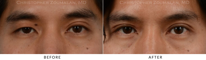 Asian Eyelid (Double Eyelid) Surgery Before & After Photo -  - Patient 12