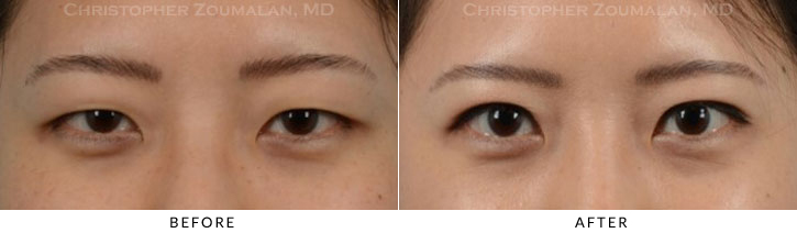 Asian Eyelid (Double Eyelid) Surgery Before & After Photo -  - Patient 13