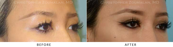 Asian Eyelid (Double Eyelid) Surgery Before & After Photo - Patient Seeing Side - Patient 14A