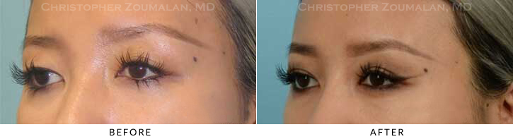 Asian Eyelid (Double Eyelid) Surgery Before & After Photo - Patient Seeing Side - Patient 14B