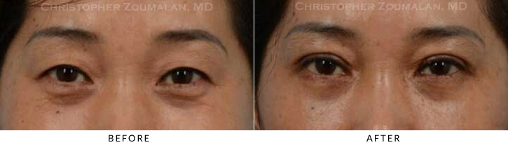 Asian Eyelid (Double Eyelid) Surgery Before & After Photo - Patient Seeing Straight - Patient 15A