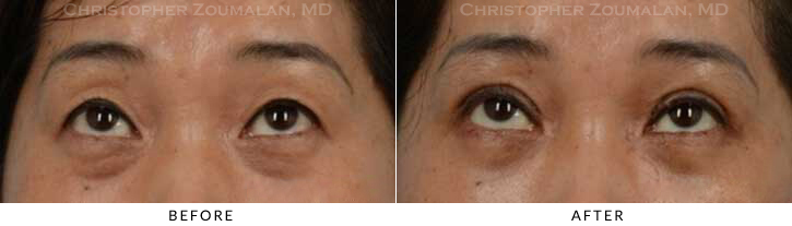 Asian Eyelid (Double Eyelid) Surgery Before & After Photo - Patient Seeing Up - Patient 15B