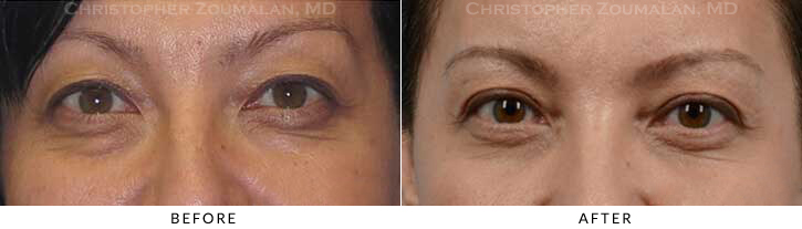 Asian Eyelid (Double Eyelid) Surgery Before & After Photo - Patient Seeing Straight - Patient 16A