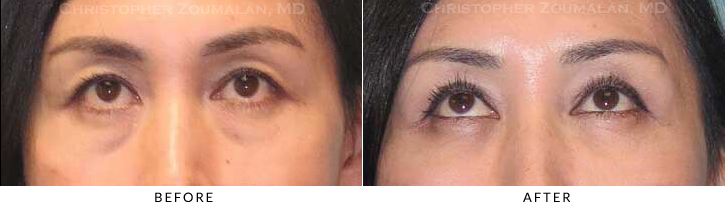 Asian Eyelid (Double Eyelid) Surgery Before & After Photo - Patient Seeing Up - Patient 17A