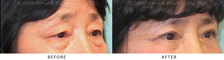 Asian Eyelid (Double Eyelid) Surgery Before & After Photo - Patient Seeing Side - Patient 18A