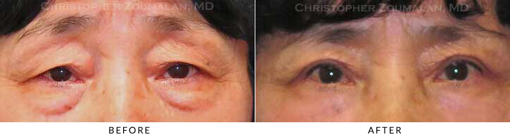 Asian Eyelid (Double Eyelid) Surgery Before & After Photo - Patient Seeing Straight - Patient 18B