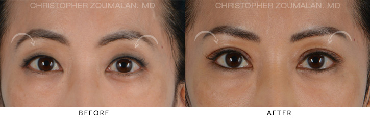 Asian Eyelid (Double Eyelid) Surgery Before & After Photo - Patient Seeing Straight - Patient 1A