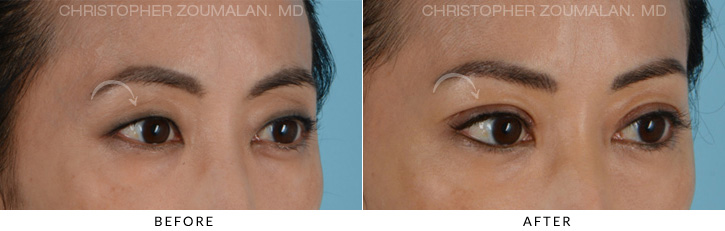 Asian Eyelid (Double Eyelid) Surgery Before & After Photo - Patient Seeing Side - Patient 1C