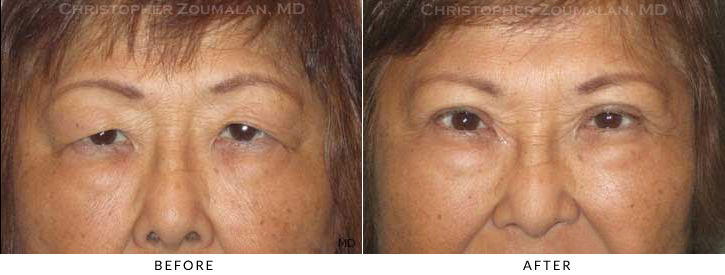 Asian Eyelid (Double Eyelid) Surgery Before & After Photo -  - Patient 20