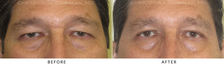 Asian Eyelid (Double Eyelid) Surgery Before & After Photo -  - Patient 21