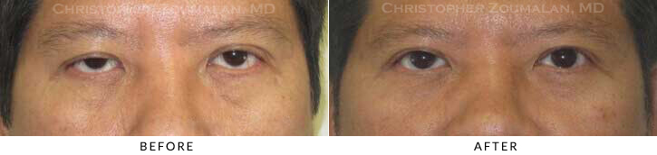 Asian Eyelid (Double Eyelid) Surgery Before & After Photo -  - Patient 24