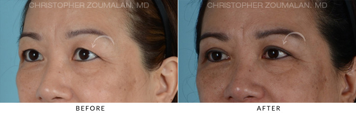 Asian Eyelid (Double Eyelid) Surgery Before & After Photo - Patient Seeing Side - Patient 2A