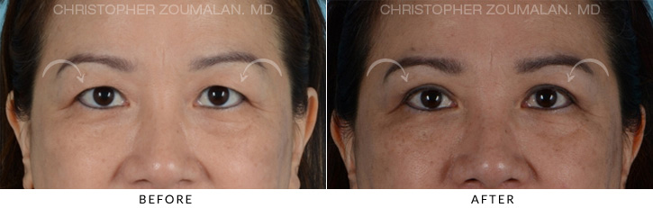 Asian Eyelid (Double Eyelid) Surgery Before & After Photo - Patient Seeing Straight - Patient 2B