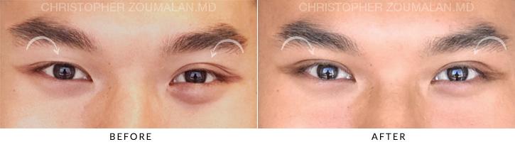 Asian Eyelid (Double Eyelid) Surgery Before & After Photo -  - Patient 3