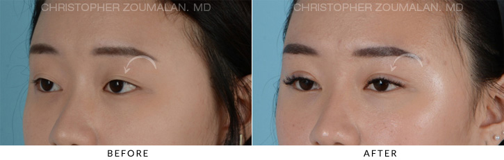 Asian Eyelid (Double Eyelid) Surgery Before & After Photo - Patient Seeing Side - Patient 4B