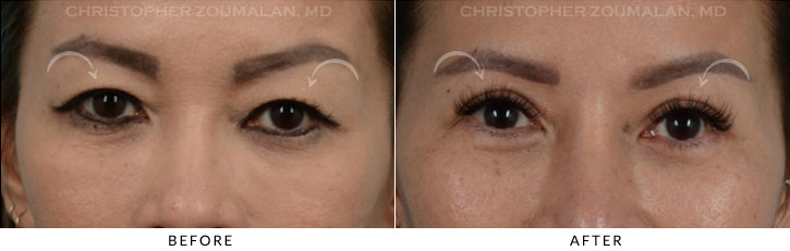 Asian Eyelid (Double Eyelid) Surgery Before & After Photo - Patient Seeing Straight - Patient 5A