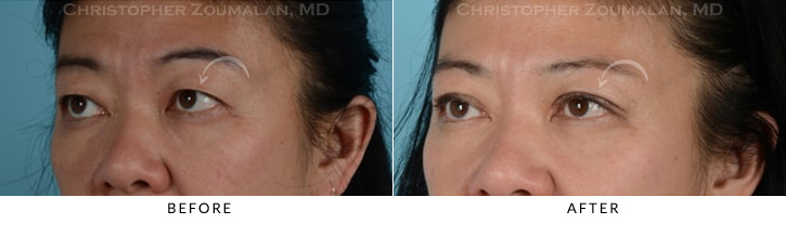 Asian Eyelid (Double Eyelid) Surgery Before & After Photo -  - Patient 6