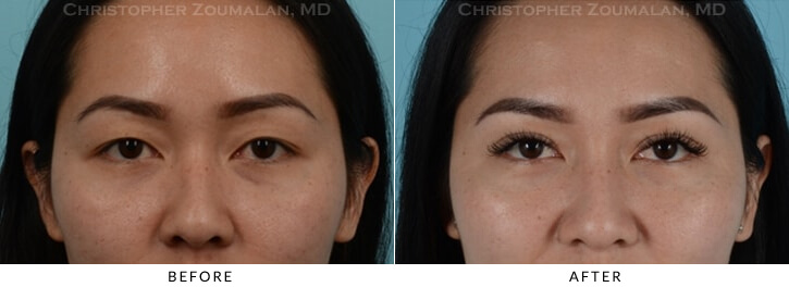 Asian Eyelid (Double Eyelid) Surgery Before & After Photo - Patient Seeing Straight - Patient 7A