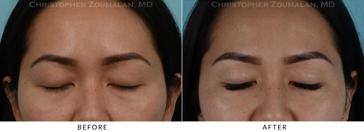 Asian Eyelid (Double Eyelid) Surgery Before & After Photo - Patient with Eyes Closed - Patient 7B