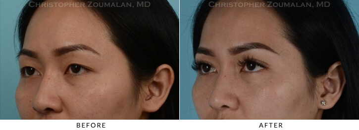 Asian Eyelid (Double Eyelid) Surgery Before & After Photo - Patient Seeing Side - Patient 7C