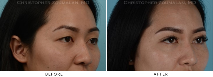 Asian Eyelid (Double Eyelid) Surgery Before & After Photo - Patient Seeing Side - Patient 7D