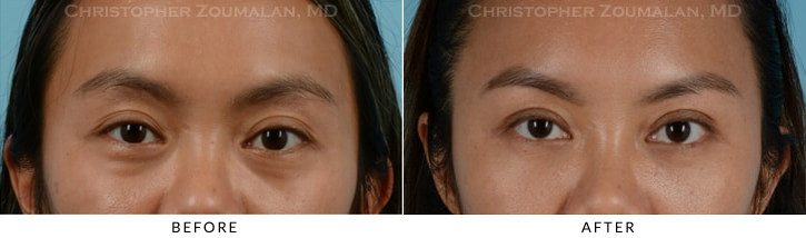 Asian Eyelid (Double Eyelid) Surgery Before & After Photo - Patient Seeing Straight - Patient 8A