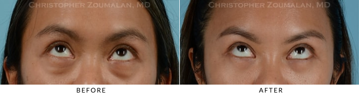 Asian Eyelid (Double Eyelid) Surgery Before & After Photo - Patient Seeing Up - Patient 8B