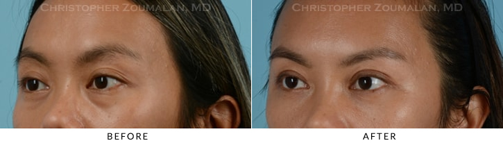 Asian Eyelid (Double Eyelid) Surgery Before & After Photo - Patient Seeing Side - Patient 8C