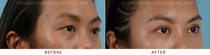 Asian Eyelid (Double Eyelid) Surgery Before & After Photo - Patient Seeing Side - Patient 8D