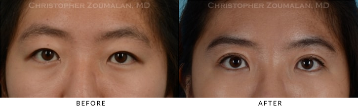 Asian Eyelid (Double Eyelid) Surgery Before & After Photo - Patient Seeing Straight - Patient 9A