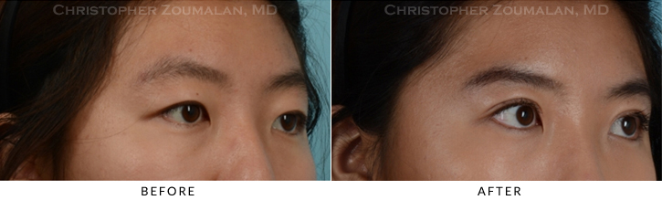 Asian Eyelid (Double Eyelid) Surgery Before & After Photo - Patient Seeing Side - Patient 9B