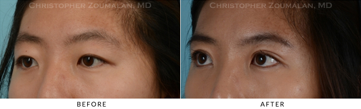 Asian Eyelid (Double Eyelid) Surgery Before & After Photo - Patient Seeing Side - Patient 9C