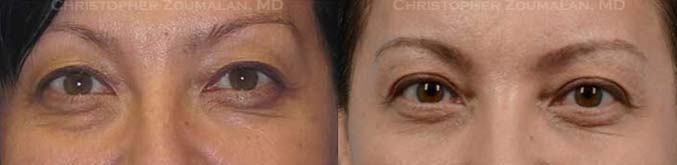 Upper and lower eyelid blepharoplasty, fat repositioning to lower eyelids - female Patient before and after picture