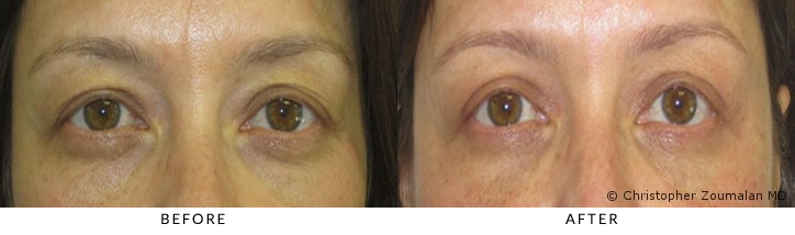 Bilateral upper lid ptosis repair, upper and lower lid blepharoplasty, periorbital and lower lid fat grafting. - Patient before and after picture