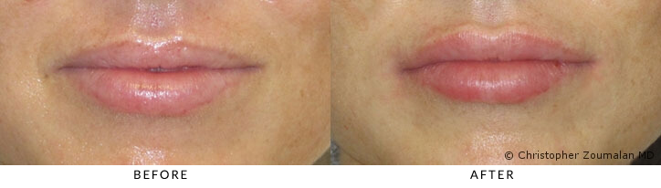 Hyaluronic acid (HA) fillers were used to augment the upper lip to allow for a more natural and youthful look - Female patient before and after picture.