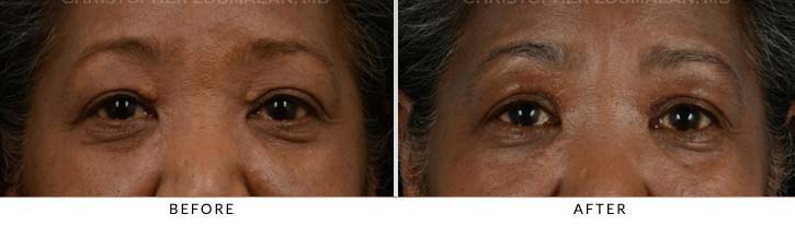 This patient had cholesterol deposits that can sometimes form on the eyelid, the condition is called xanthelasma - female patient before and after picture